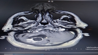 Kastamonu’da beyinciğinden portakal büyüklüğünde tümör çıkarılan hasta sağlığına kavuştu