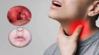 Strep A Enfeksiyonu Nedir, Belirtileri Neler? Bulaşıcı mı?